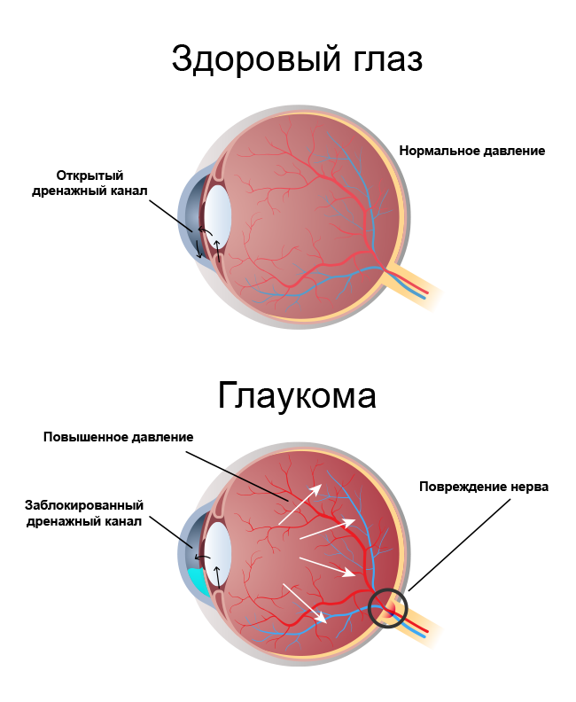 Глаукома признаки лечения. Кольцевидная глаукома. Глаукома схема глаза. Открытоугольная глаукома симптомы. Терминальная глаукома.